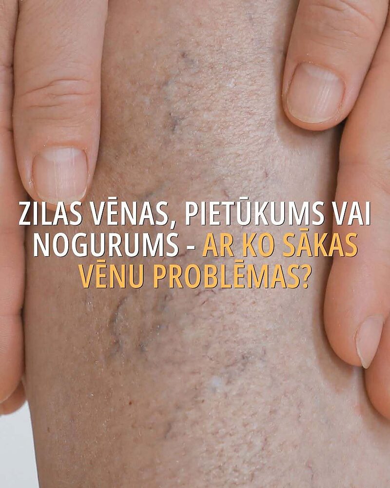 Zilas vēnas, pietūkums vai nogurums - ar ko sākas vēnu problēmas?